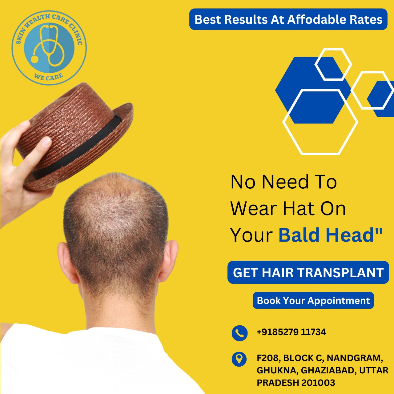 Hair Transplant in Ghaziabad